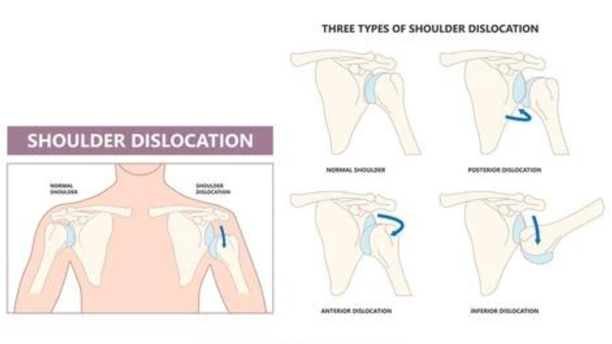 Preventing Shoulder Dislocations Essential Tips for Maintaining