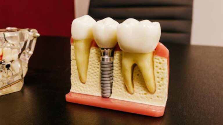 Dental Implants